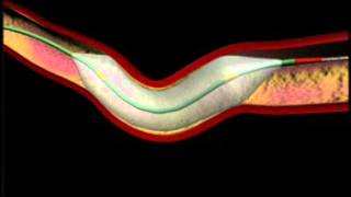 Balloon Angioplasty and Stenting Animation [upl. by Hulburt522]