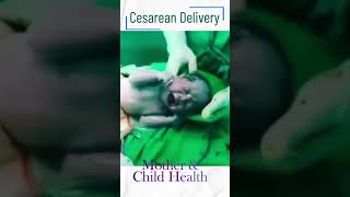 Csection  Cesarean Delivery [upl. by Ainiger468]