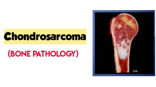 ChondrosarcomaBone pathologyRobbins pathologybone tumorforward focused [upl. by Westlund]