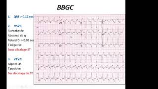 Le syndrome coronarien aigu ST  Dr Ben Massoud [upl. by Elletnohs103]