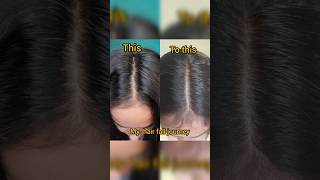 Hair fall journey hairfall hairloss haircare shorts hairlosstreatment hairfallsolution yt [upl. by Waiter784]