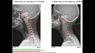 How To Correct Forward Head Posture and Cervical Lordosis With The Cervical Vibratory Traction [upl. by Tnilk]