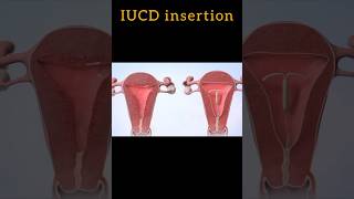 iucd and copper T insertion  3D animation video shorts iucd copperT [upl. by Wilda]