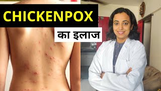 Chickenpox Treatment in Hindi  Chicken Pox का इलाज कैसे करें [upl. by Elitnahc]