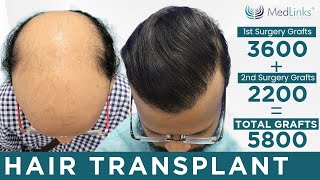 💥Best Hair Transplant Results in Delhi 2024 India  Best Hair Transplant Clinic in Delhi  Medlinks [upl. by Aibsel28]