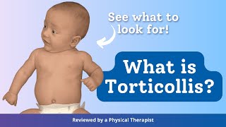 What is Torticollis [upl. by Noillimaxam]