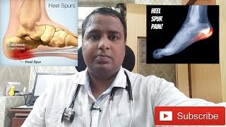 HEEL PAINCALCANEAL SPUR TREATMENTएड़ी के दर्द का इलाज [upl. by Schmidt]