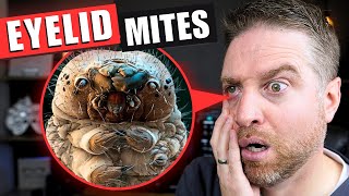 How to Get Rid Of Eyelid Mites That Cause Demodex Blepharitis [upl. by Sonnnie846]