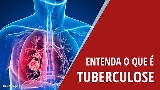 Entenda o que é Tuberculose [upl. by Auqemahs]