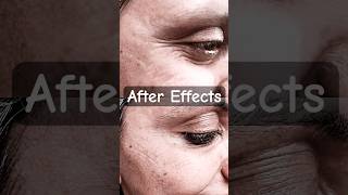 GET WRINKLE FREE SKIN WITH BOTOX hermosaclinique6252 botox crowsfeet wrinkles wrinklefree [upl. by Michaela973]