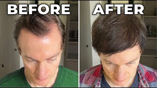 How I Reversed My Hair Loss  Greying [upl. by Eniamzaj889]