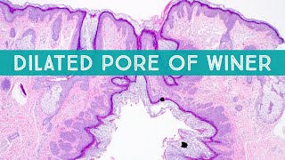 Dilated Pore of Winer Under Microscope Dermpath in 5 Minutes [upl. by Deth]