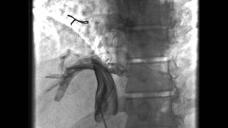 Stenosed Intrahepatic segment of IVC [upl. by Ziladnerb521]