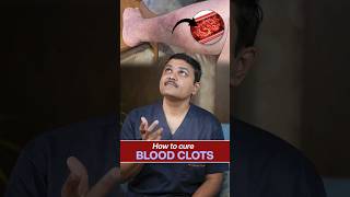 How to Treat Blood Clots Insights from vascularsurgeon shortvideo [upl. by Heiney408]