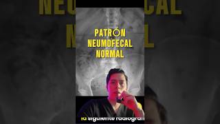 Patron neumofecal normal en la radiografía de abdomen rayosx radiologia medicina salud [upl. by Joela]