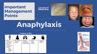 Anaphylaxis  Important Management Points [upl. by Nosmirc]