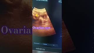 Lower abdomen scan Right ovarian cyst ultrasound usg ovary cystic [upl. by Dermot]