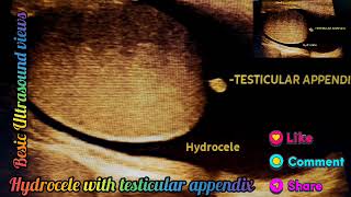 Hydrocele with testicular appendix in ultrasound usg views [upl. by Enitsirc]