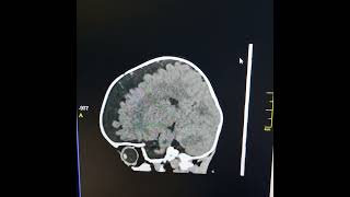 Agenesis of corpus callosum  External hydrocephalus [upl. by Pickering]