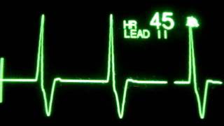 Accelerated Ventricular Rhythm AVR [upl. by Silecara]