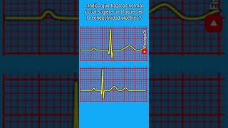 Electrocardiograma interpretación  ¿Indica que trazo es normal y cual sugiere un bloqueo [upl. by Elberta]