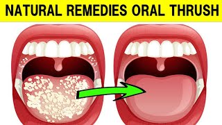 How To Treat Oral Thrush With Natural Remedies [upl. by Joshuah]