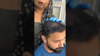 Dandruff treatment full video uploaded dandruff [upl. by Elisabet324]