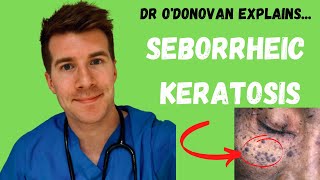 Explaining Seborrheic Keratosis  With Dr ODonovan [upl. by Hunter925]