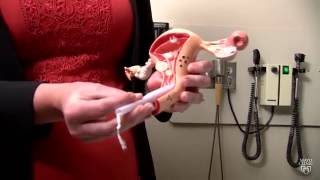 Mayo Clinic Minute Tampon test for endometrial cancer [upl. by Reeva977]