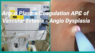 Angio Dysplasia or Vascular Ectasia Argon Plasma Coagulation APC  SQUARE HOSPITAL LTD BDENDOSCOPY [upl. by Henriette]