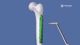 Fracture col du fémur et trochanter  Chirurgie ostéosynthèse par vissage DHS  Dr Simon Tournemine [upl. by Batory763]