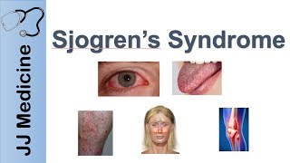 Sjogren’s Syndrome quotDry Eye Syndromequot  Primary vs Secondary Symptoms Diagnosis and Treatment [upl. by Zaccaria329]