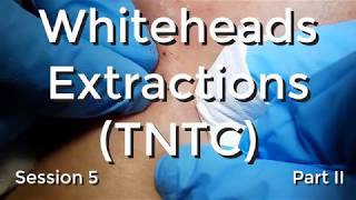 Whiteheads Extraction TNTC  Session 5 Part II [upl. by Gitt]