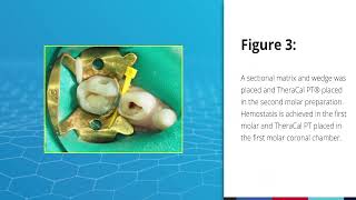 Exposed Dental Pulp Case Using TheraCal PT [upl. by Aldarcy]