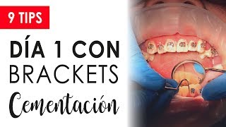 PRIMER DÍA CON BRACKETS CEMENTACIÓN  QUÉ HACER Y QUÉ NO HACER [upl. by Ylecara]