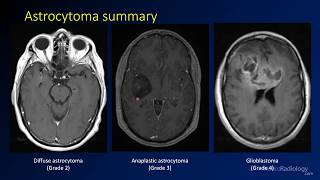 Imaging brain tumors  2  Astrocytomas [upl. by Gelhar]