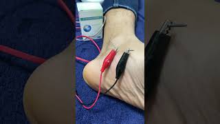 Dry needling  Tendinite de jambier posterieur douleur au pied [upl. by Martelle326]