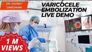 Live Varicocele Embolization Case 1 Nonsurgical treatment of Varicocele  Dr Gaurav Gangwani [upl. by Santoro934]