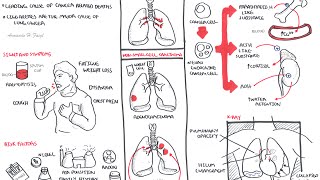 Lung Cancer  Overview [upl. by Soneson]