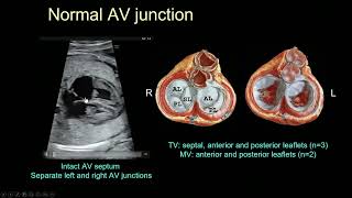 2024 Fetal Echocardiography Normal and Abnormal Hearts  A Video CME Teaching Activity [upl. by Hannan]