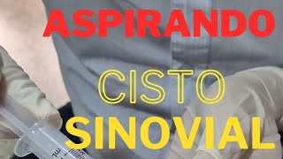 Aspirando um Cisto Sinovial [upl. by Adnoek]