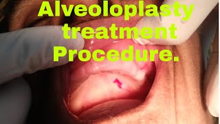 Alveoloplasty  local anaesthesia  suture  bone cutting  injections  bone spicule  denture [upl. by Siseneg725]