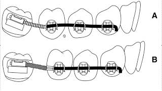 How to Upright a MesioAngulated Impacted Second Molar in Orthodontics [upl. by Thaddeus]