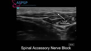 Ultrasound Guided Spinal Accessory Nerve Block [upl. by Middlesworth]