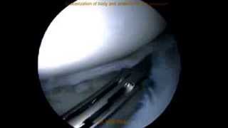 Arthroscopic quotsaucerizationquot menisectomy of Discoid Lateral Meniscus by Dr Mihir Patel Mumbai [upl. by Arielle]