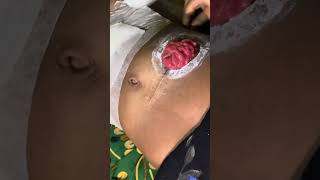 Stoma Bag Description Bangla  Surgery Short Case medical surgeryday injury belly abdomen [upl. by Aicia638]