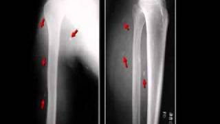 LearningRadiology 27 Soft Tissue Calcifications II [upl. by Amedeo]