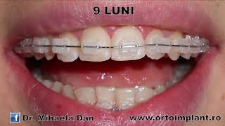 Aparat dentar Fix Ceramic Adulti  rezultat in 15 luni [upl. by Krahling985]