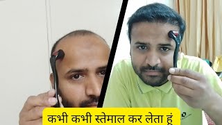 Best Hair Grow Results After Use Minoxidil And Derma Roller  How to stop hair Genetic Loss Fall [upl. by Rainie610]