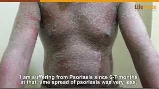 Patient having severe Psoriasis gets treated at Life Force Homeopathy [upl. by Lilahk]